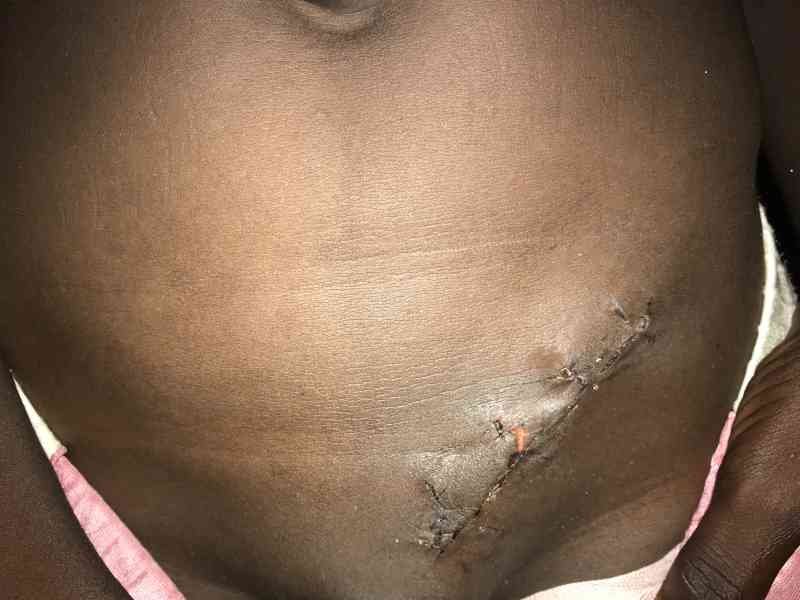 La cicatrice d’une opération chirurgicale photo gratuite